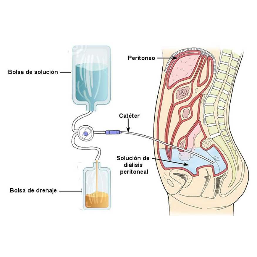 Detalle del servicio Diálisis peritoneal 2